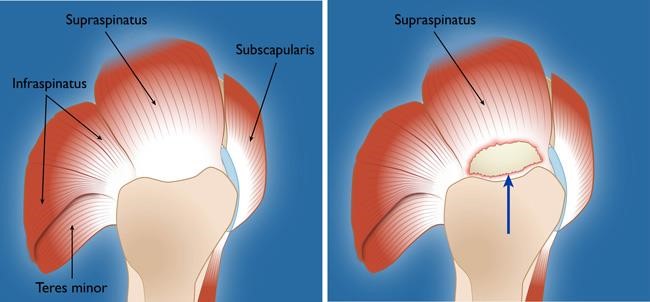 Rotator cuff tendons and a full-thickness tear in the supraspinatus tendon