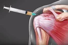 Cortisone injection in the shoulder