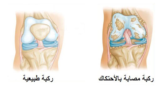 زراعة المفصل الصناعي للركبة - مركز الدكتور اسعد احمد لجراحة المفاصل والطب الرياضي
