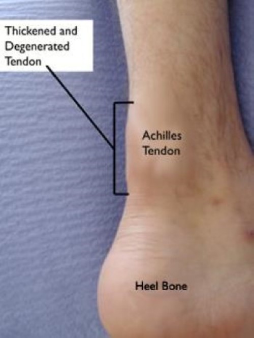 Noninsertional Achilles tendinitis