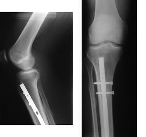 الأشعة السينية وعلاج الكسور جراحيًا