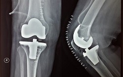 احتكاك و خشونة الركبة: العلاج الجراحي - مركز الدكتور اسعد احمد لجراحة المفاصل والطب الرياضي