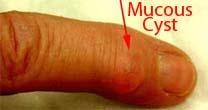 Mucous cyst on finger