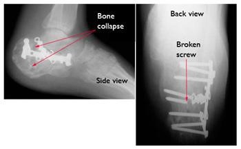 Hardware failure after fixation for calcaneus (heel bone) fracture