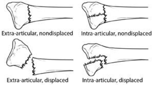 types of distal radius fractures