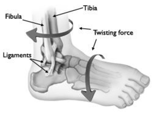 twisting force causing ankle sprain or fracture
