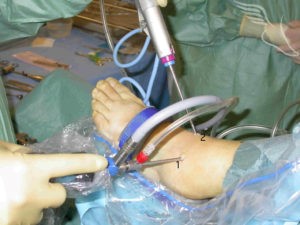 https://www.thefootandankleclinic.com/content/uploads/2018/02/ankle-arthroscopy-25-1-300x225.jpg
