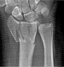 x-ray of distal radius fracture