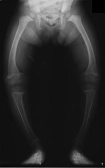صورة بأشعة إكس لطفل عمره سنتين مصاب بالكساح (لين العظام).