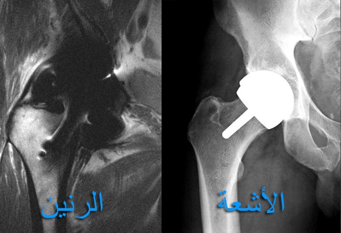 https://hip-knee.com/wp-content/uploads/2013/10/MRIartifact.jpg