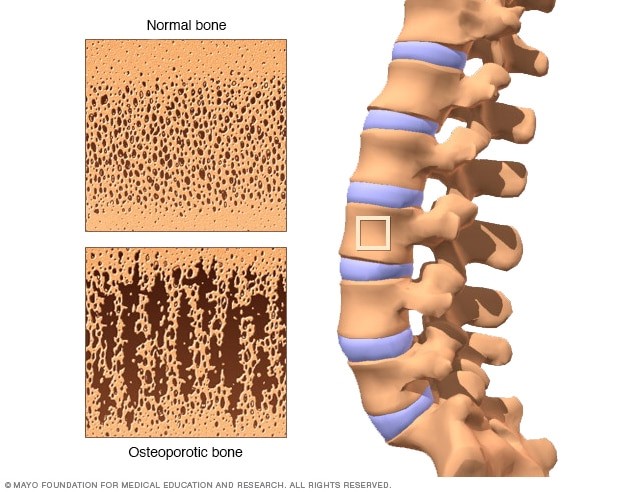 مقارنة الأجزاء الداخلية للعظم الصحي بالعظام الذي أصبح مساميًا بسبب مرض هشاشة العظام.