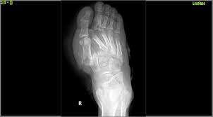 X-rays of Lisfranc injury