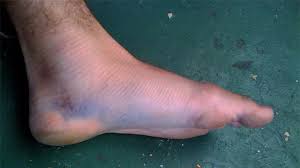 Bruising on bottom of foot