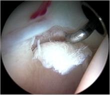 https://upload.wikimedia.org/wikipedia/commons/thumb/9/98/Figure_8._Cartilage_delamination._A_small_area_of_acetabular_cartilage_has_lifted_from_the_underlying_bone%2C_being_demonstrated_by_use_of_the_arthroscopic_probe..png/220px-thumbnail.png
