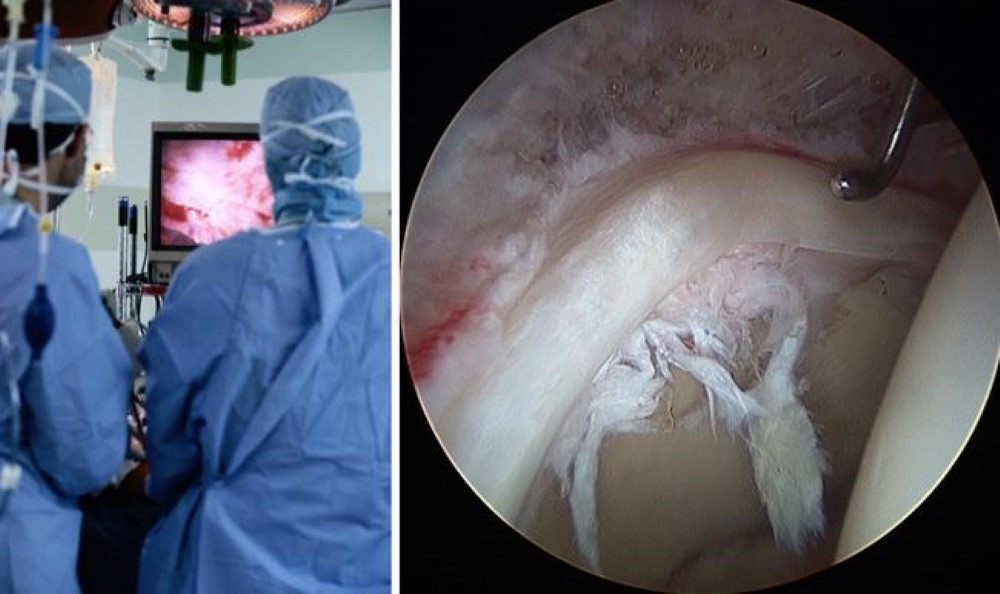 Photo of operating room during arthroscopy and arthroscopic photo taken of damaged hip joint
