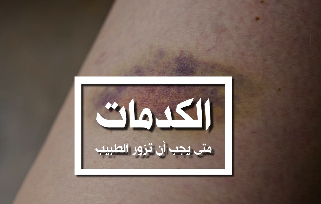 الكَدَمات او (الرضوض) >>>Contusion or bruise الدكتور مازن كردية