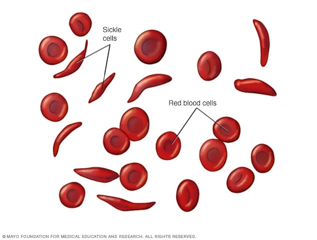 خلايا الدم الحمراء الطبيعية والخلايا المنجلية
