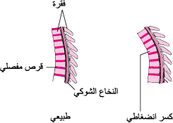 الكُسُورُ الانضِغاطية في العمود الفقري Compression Fractures of the Spine