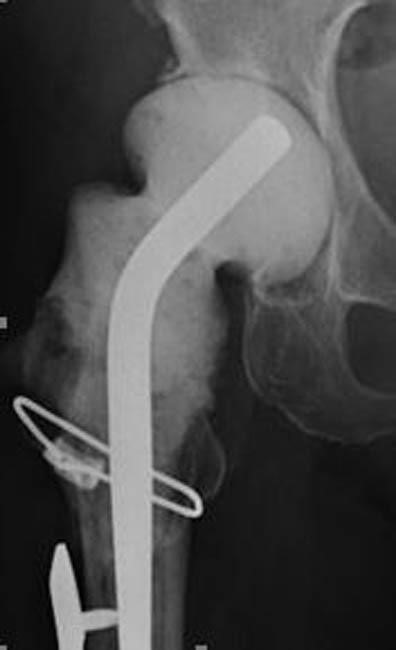 Antibiotic spacer in hip joint