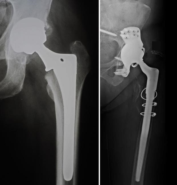 X-rays showing primary and revision total hip replacement