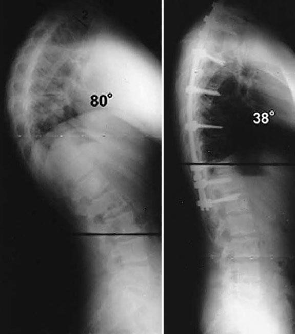 X-rays of a kyphotic curve before and after spinal fusion