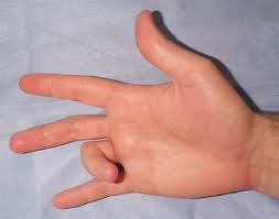 (أ) يد مصابة بانكماش دوبوترين