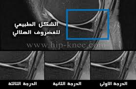 https://hip-knee.com/wp-content/uploads/2013/10/MRImeniscus.jpg