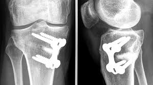 https://upload.wikimedia.org/wikipedia/commons/thumb/2/2e/Osteotomy_tibia_en.svg/220px-Osteotomy_tibia_en.svg.png