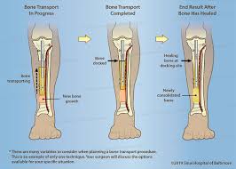 رسم توضيحي لقصبة الساق يُظهر الخطوات الثلاث الأخيرة في نقل العظام باستخدام مسمار داخلي - نقل العظم قيد التقدم ، ونقل العظم الكامل ، والنتيجة النهائية بعد التئام العظم