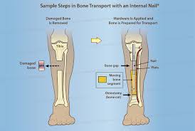 رسم توضيحي لقصبة الساق يُظهر أول خطوتين في نقل العظام باستخدام مسمار داخلي - إزالة العظم التالف ثم تطبيق الأجهزة لتحضير العظم للنقل
