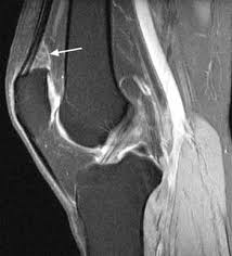 Fig 6. Prefemoral fat pad impingement in a 42-year-old woman with...