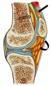 Anatomy of the peripatellar fat pads. The suprapatellar fat pad (solid straight arrow) is triangular in shape, located superior to the patella, posterior to the quadriceps tendon and anterior to the suprapatellar recess. The prefemoral fat pad (empty arrow) is anterior to the distal shaft of the femur and posterior to the suprapatellar recess. Infrapatellar fat pad (Hoffa fat pad) (curved arrow) is inferior to the patella, posterior to the patellar tendon, and anterior to the intercondylar notch. 