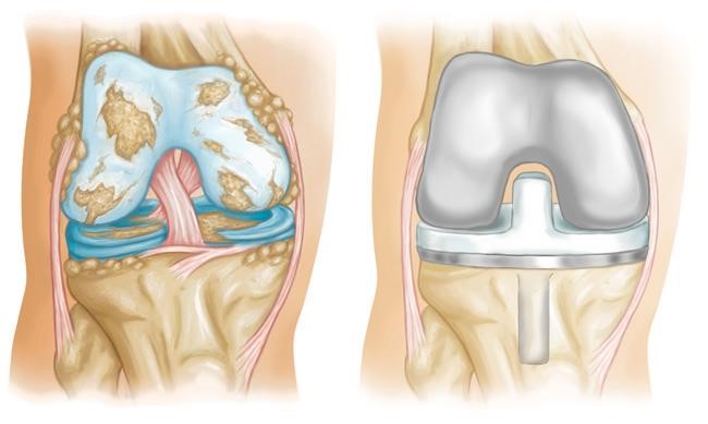 Damaged knee and knee replacement