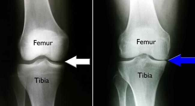 تظهر الأشعة السينية مساحة طبيعية للمفاصل في الركبة وهشاشة العظام على جانب واحد من الركبة