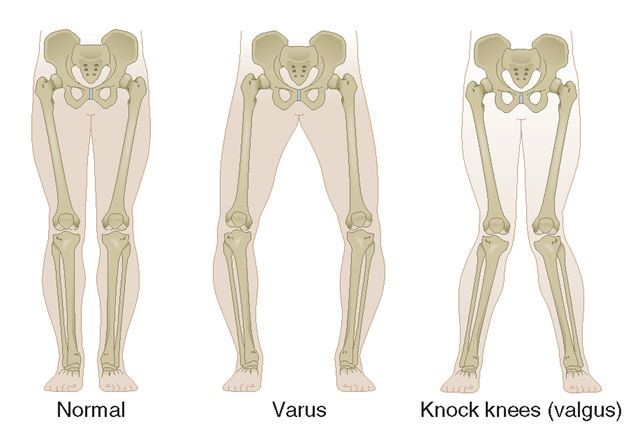 http://www.sydneyknee.com.au/images/alignment-diagram-knee.jpg