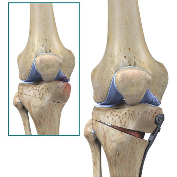 http://www.sydneyknee.com.au/images/x-ray-high-tibial-osteotomy.jpg