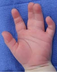 ارتفاق الأصابع البسيط غير المكتمل قبل الجراحة