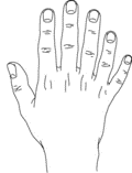 https://upload.wikimedia.org/wikipedia/commons/thumb/e/e6/Polydactyly_postaxial.gif/120px-Polydactyly_postaxial.gif