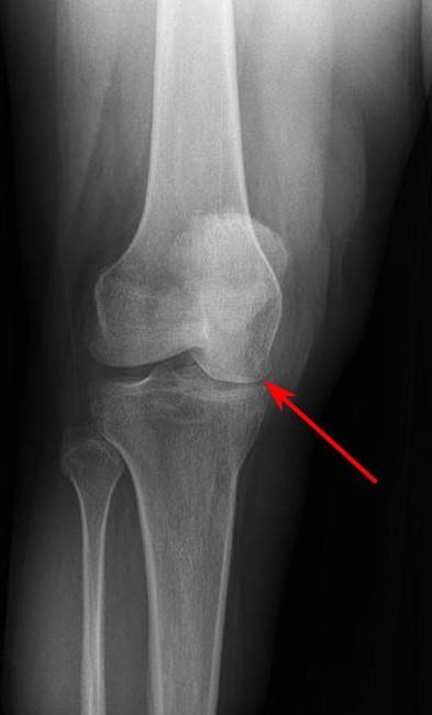الأشعة السينية للنخر العظمي في الطرف السفلي لعظم الفخذ