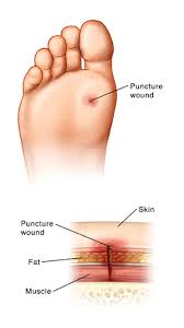 Sole of foot with puncture wound. Cross section of skin showing puncture wound.