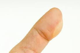 A blister on a finger.