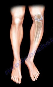 Valgus Knee Deformity. When the knee is not perfectly aligned… | by Nabil  Ebraheim | Medium
