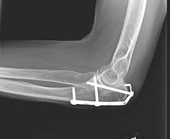 Olecranon fracture held together with a tension band