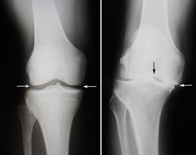 صورة بالأشعة السينية لركبة صحية وركبة مصابة بهشاشة العظام