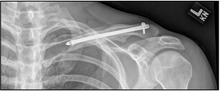 Clavicle Post-op.png