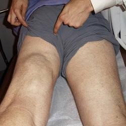 صورة لمريض يعاني من إصابة شديدة في أوتار الركبة