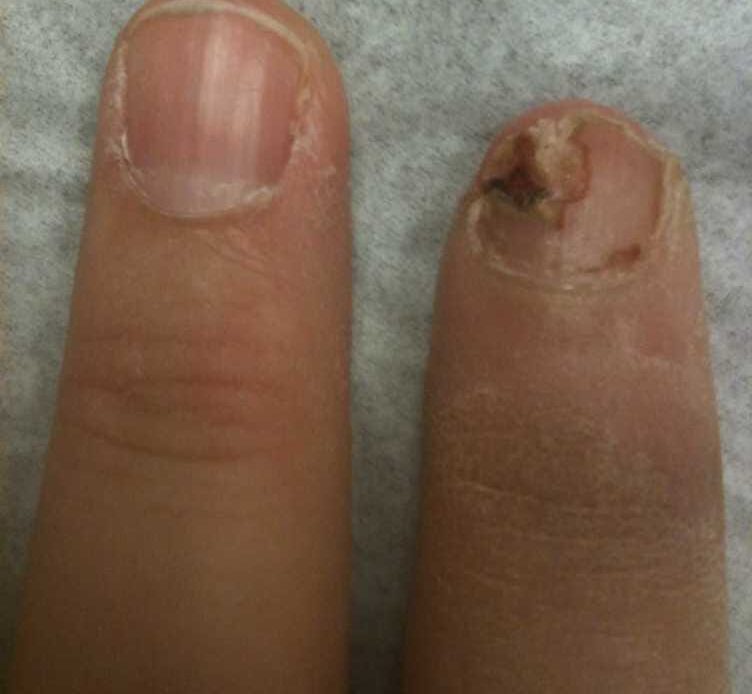علاج خلع ظفر الأصبع الأكبر